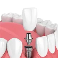 Dental Implants - Overland Park - Kansas City