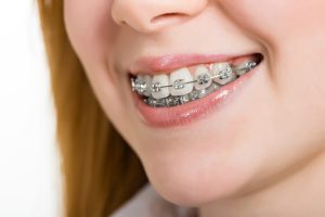 Why Straight Teeth Matter